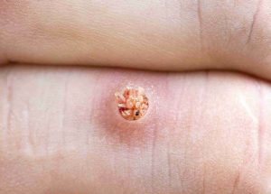 Bác sĩ Pasteur giải đáp: Có những loại mụn cóc nào?