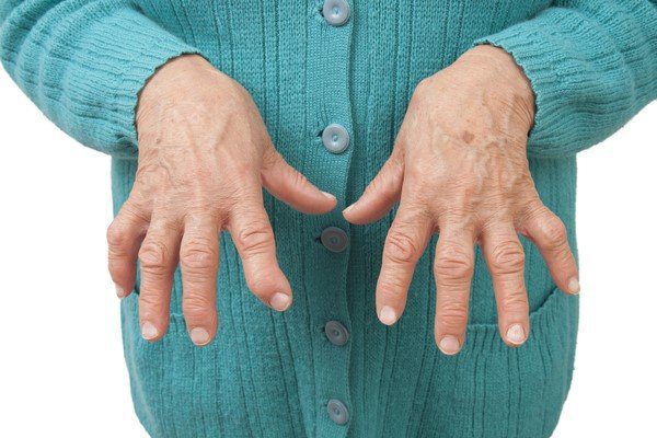 Cảnh báo những dấu hiệu của bệnh viêm khớp dạng thấp