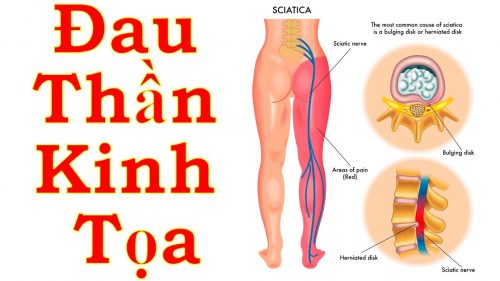 Hỏi đáp Y Dược về bệnh đau dây thần kinh tọa thường gặp ở người lao động