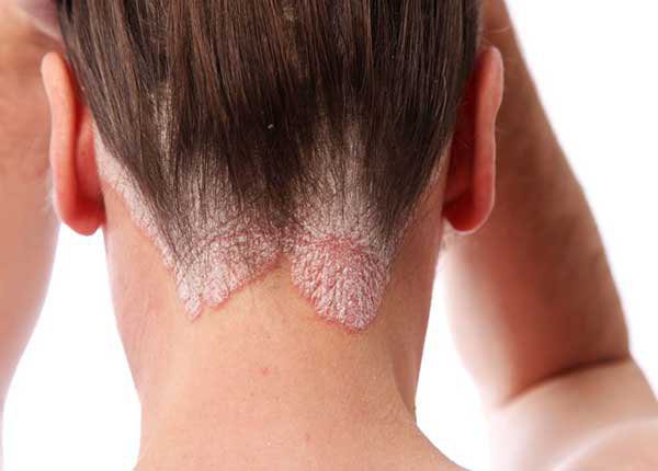 Nguyên nhân và triệu chứng của bệnh vẩy nến biểu hiện như thế nào