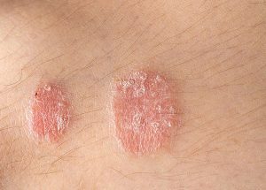 Nguyên nhân và triệu chứng của bệnh vẩy nến biểu hiện như thế nào