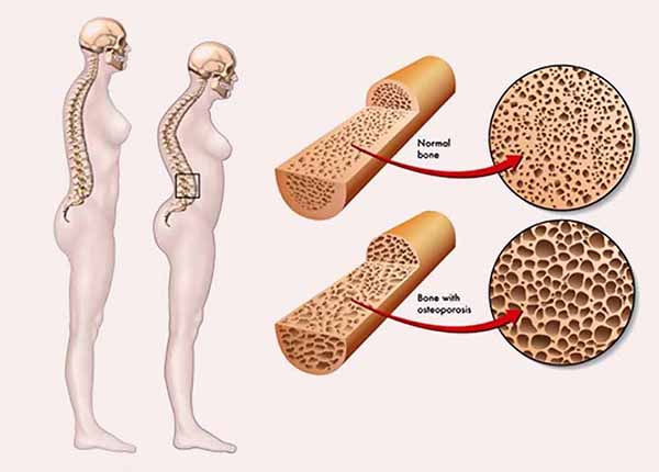 Những điều cần biết về cơ chế của bệnh loãng xương