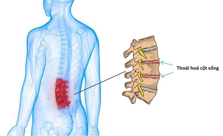 Khi bị thoái hóa cột sống cần làm gì?