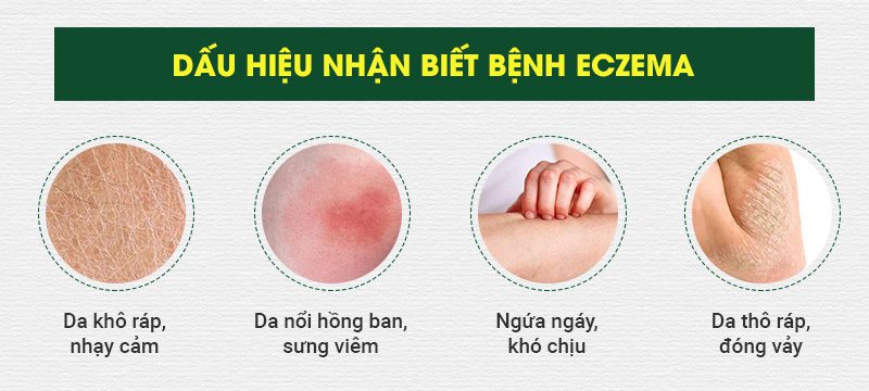 Dấu hiệu bệnh eczema