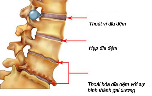 Tìm hiểu nguyên nhân và cách điều trị bệnh thoái hóa cột sống