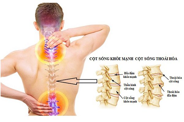 Tìm hiểu nguyên nhân và cách điều trị bệnh thoái hóa cột sống