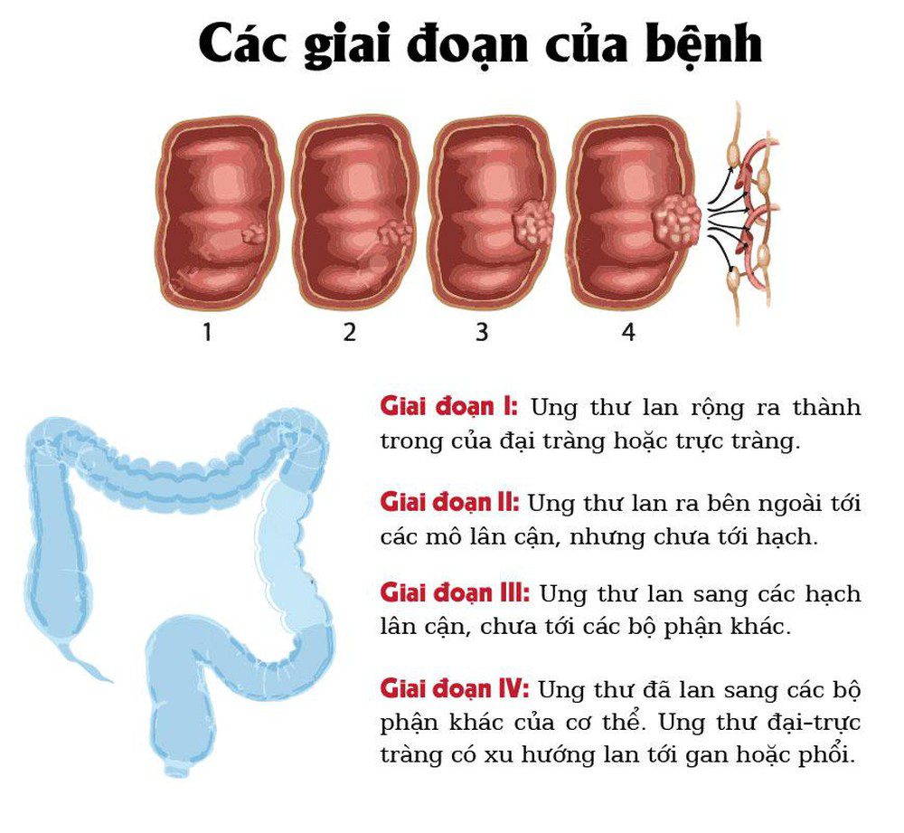 Ung thu dai trang trai co phuong phap dieu tri nao
