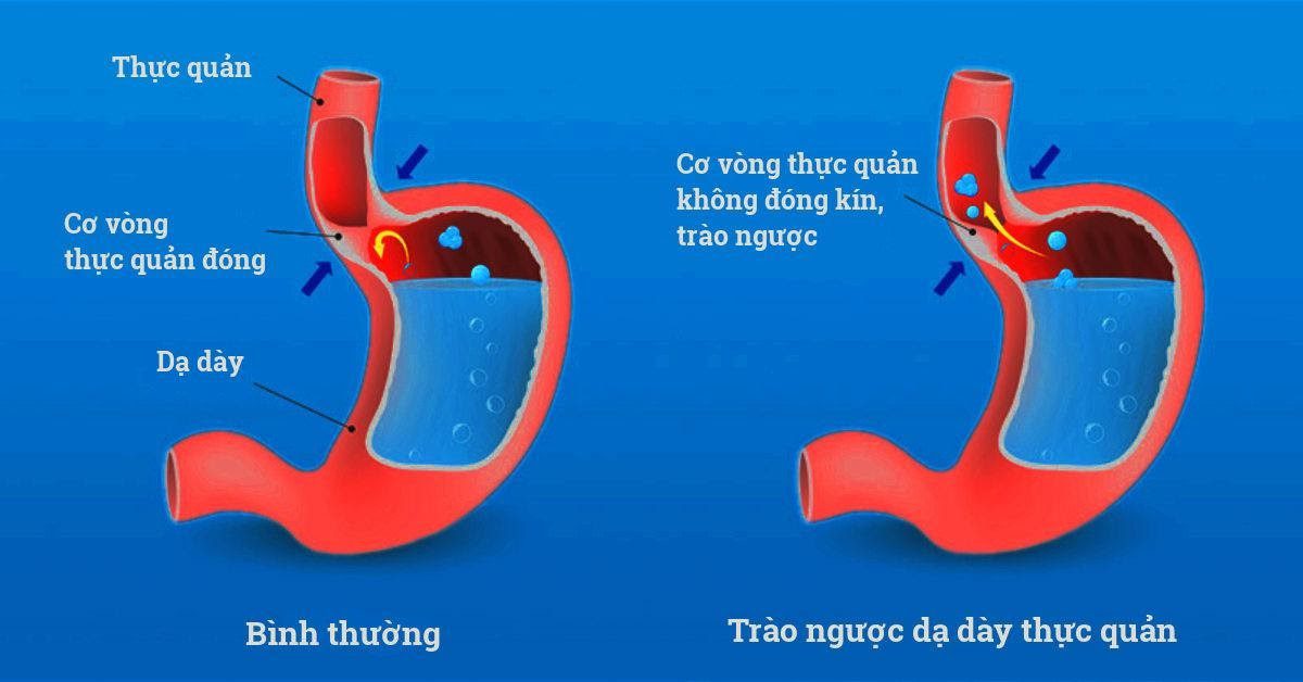 bac si chia se cach khac phuc benh co that thuc quan