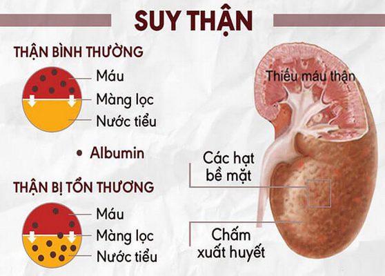 bac si chia se nhung dau hieu pho bien nhan biet benh than