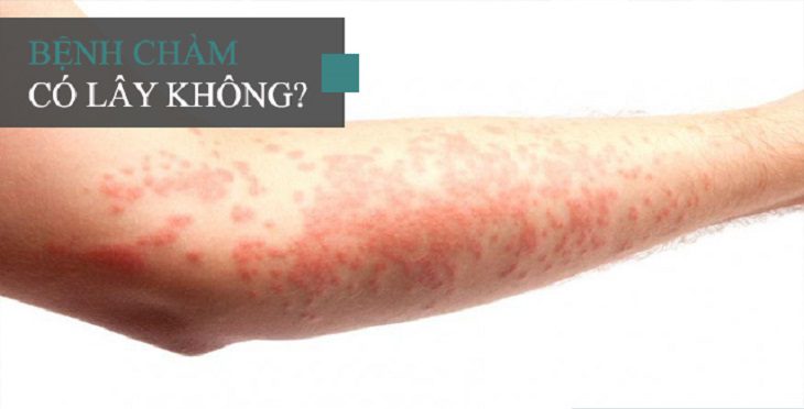 Bệnh chàm bội nhiễm có lây không?