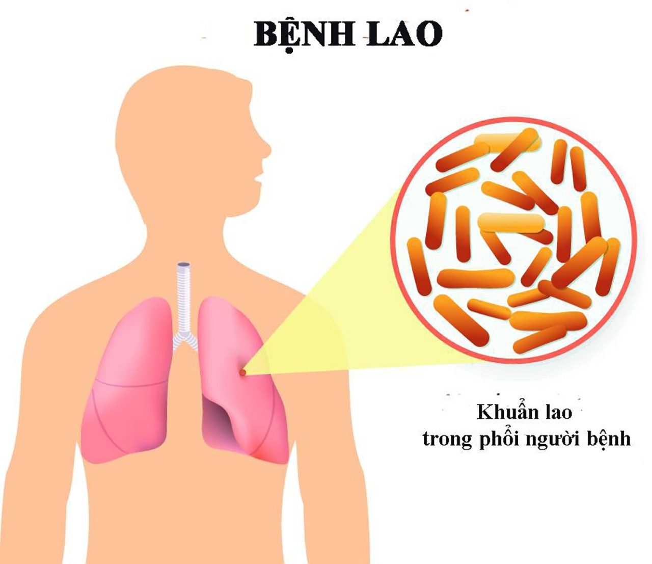 benh hoc truyen nhiem benh lao phoi lay nhiem nhu the nao 2