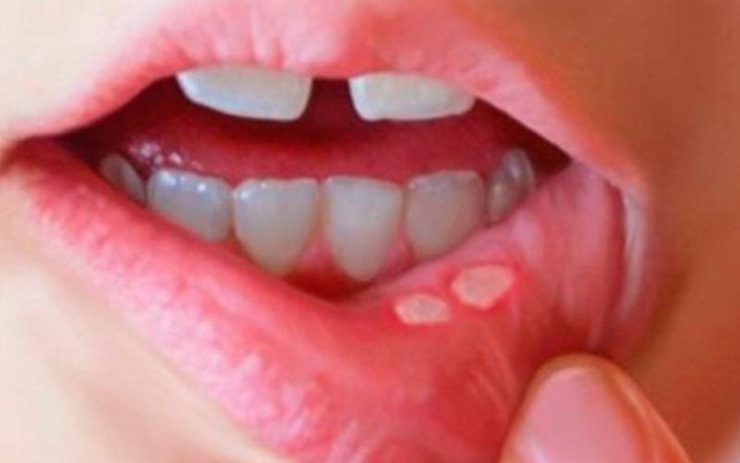  Bệnh viêm loét miệng do nguyên nhân nào gây nên ?