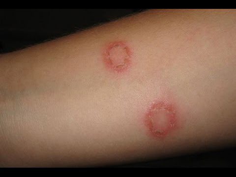 Chăm sóc bệnh nhân bị hắc lào