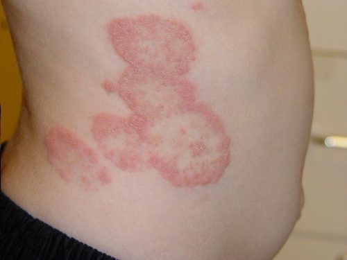 Chăm sóc bệnh nhân bị hắc lào