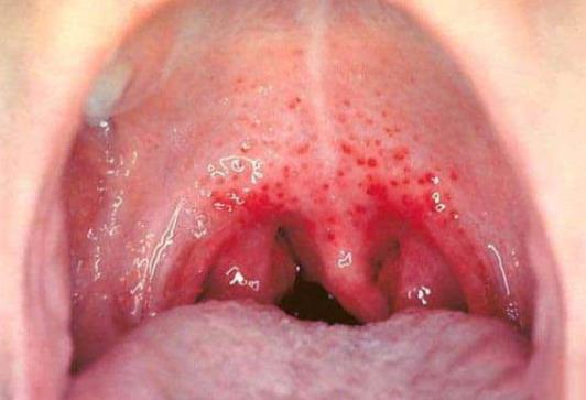 bệnh viêm họng xuất tiết 