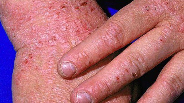 Cách điều trị bệnh eczema và những yếu tố gây nên