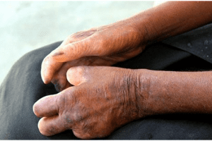 nguyen nhan va co che lay truyen benh hui