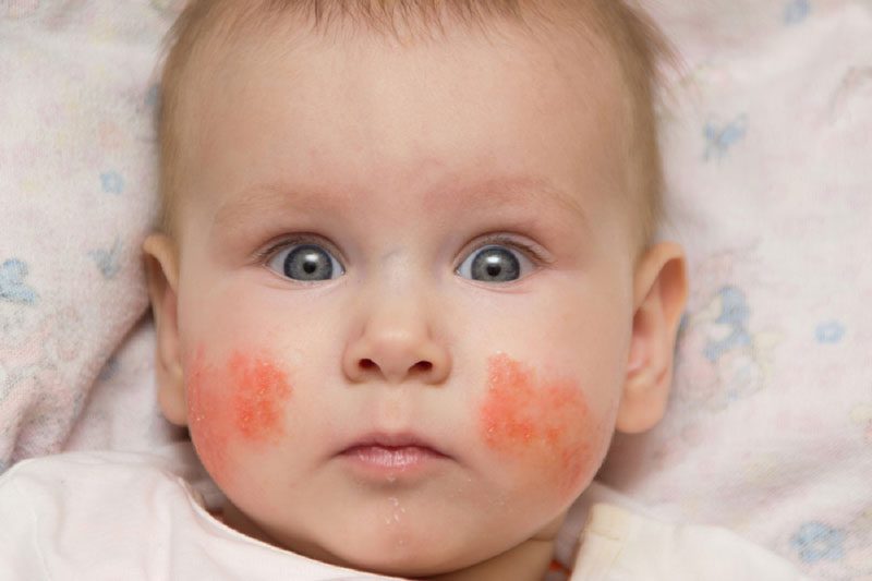 Da nổi nhiều mụn nước là một trong những dấu hiệu điển hình nhất của bệnh chàm ở trẻ em
