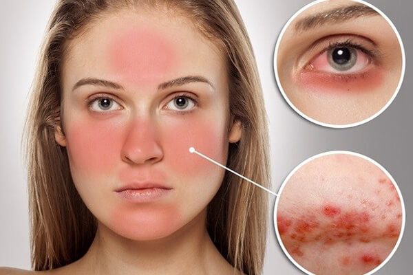 Những nguy hiểm từ biến chứng của bệnh Lupus ban đỏ hệ thống
