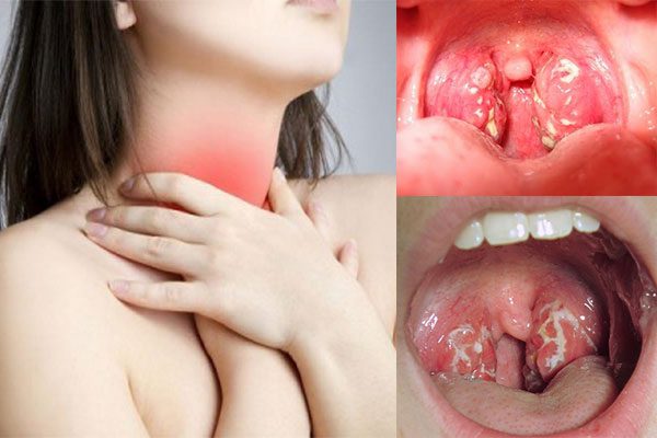 Những nguyên nhân nào khiến bệnh viêm amidan dễ tái phát