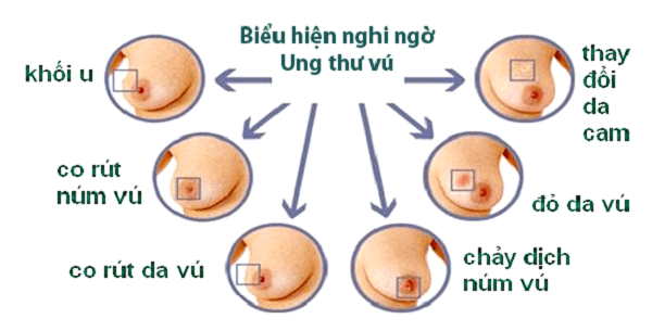 phuong phap phan biet ung thu vu va khoi u vu lanh tinh