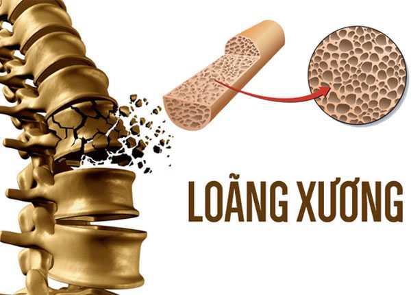Tìm hiểu những loại loãng xương phổ biến hiện nay
