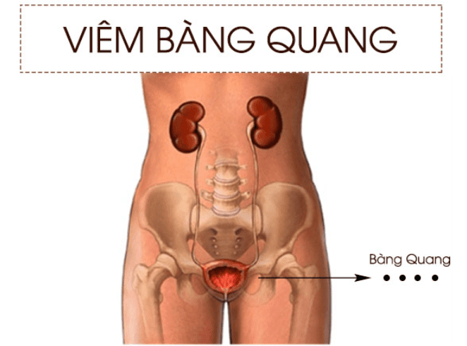 viem bang quang la gi co the phong tranh benh nhu the nao