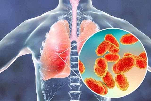 Viêm phổi cấp tính có thể gây ra nhiều biến chứng nguy hiểm