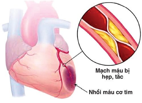 Mạch máu bị hẹp, tắc dẫn đến thiếu máu cơ tim