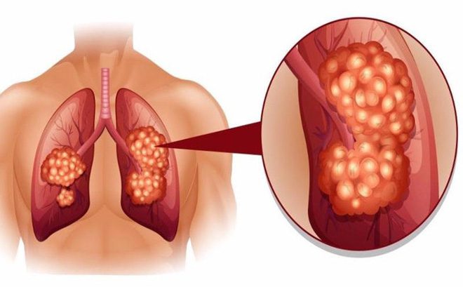 Các loại ung thư phổi