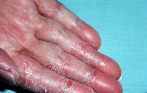 Bệnh Á sừng là căn bệnh như thế nào?