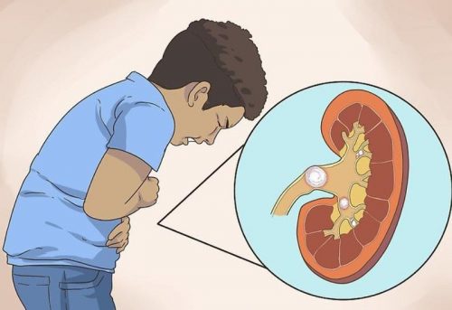 Phương pháp điều trị và phòng ngừa bệnh sỏi thận
