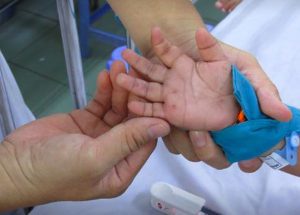 Bệnh chân tay chân miệng có tái phát lại không và bao nhiêu lần?