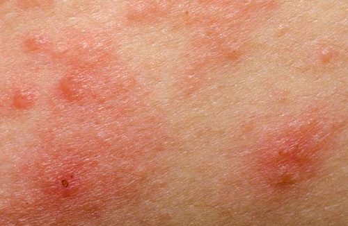 Triệu chứng lâm sàng bệnh chàm