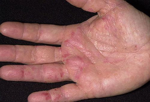 Bệnh tổ đỉa có triệu chứng bệnh như thế nào?