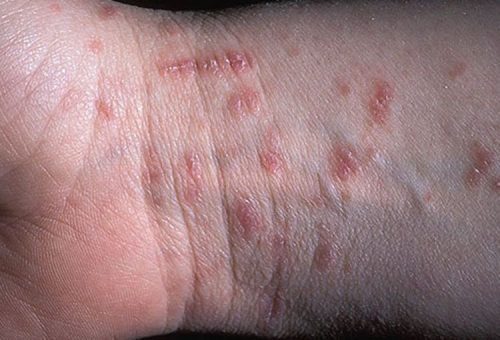 Dấu hiệu và triệu chứng của bệnh ghẻ