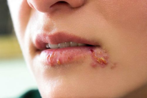 Những đối tượng nào có nguy cơ mắc bệnh loét sinh dục?