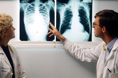 Nguyên tắc chế độ dinh dưỡng cho bệnh nhân lao phổi