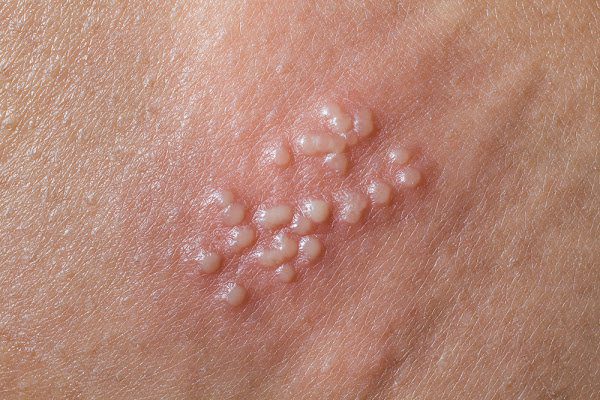 Biến chứng của bệnh lậu có nguy hiểm không?