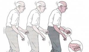 benh parkinson co dieu tri khoi khong anh huong the nao den suc khoe11467601590