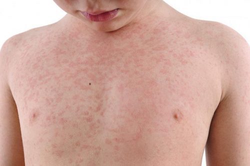Triệu chứng lâm sàng bệnh sởi