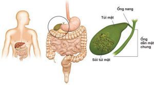 Bỏ thói quen xấu để ngừa nguy cơ bị sỏi mật sỏi thận