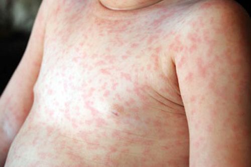 Triệu chứng của bệnh sởi trên cơ thể trẻ