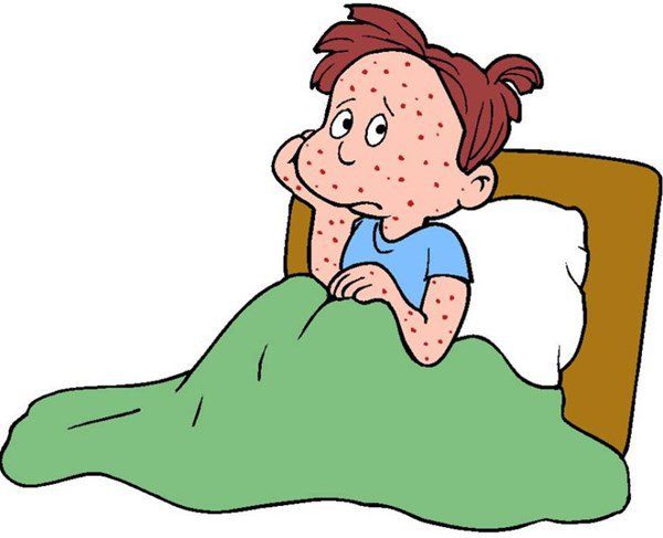Bệnh thủy đậu và những điều cần biết