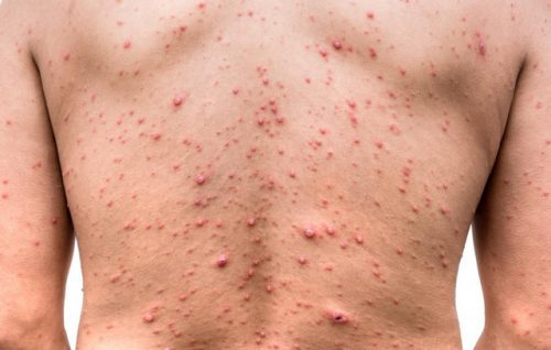Biến chứng khó lường của bệnh thủy đậu