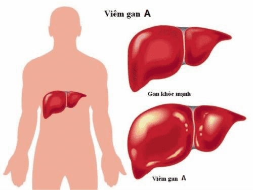 benh viem gan a e1547352911842 1