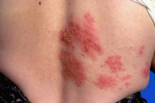 Triệu chứng lâm sàng của bệnh zona