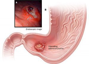 Điều dưỡng chỉ ra những dấu hiệu của ung thư dạ dày giai đoạn cuối