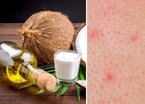 Điều dưỡng chia sẻ điều trị viêm nang lông bằng dầu dừa