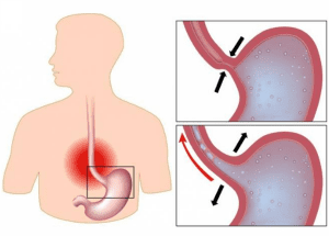 cac trieu chung thuong gap va cach chan doan benh co that thuc quan 2
